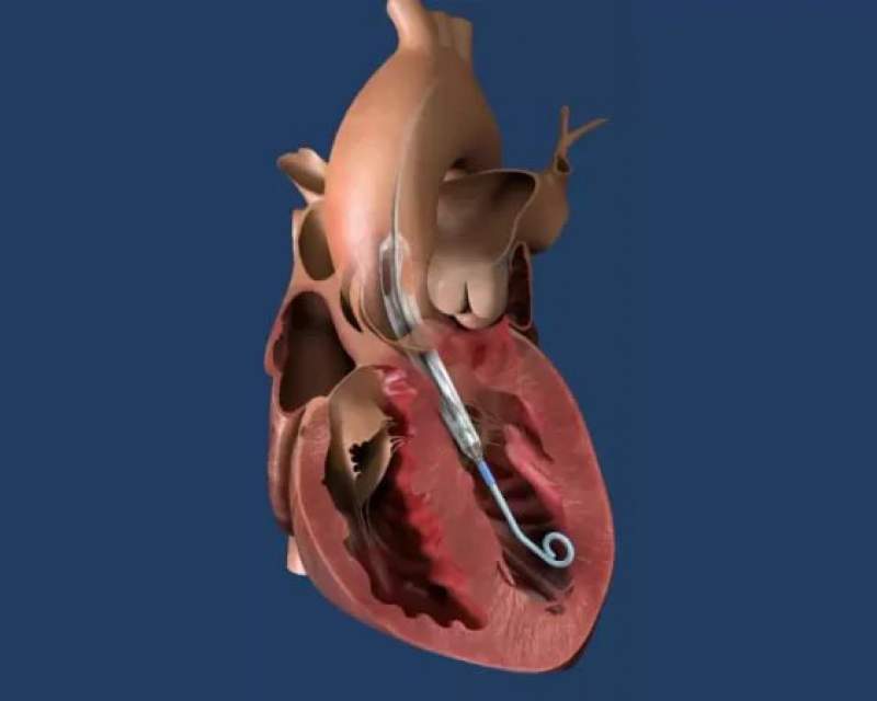 موفقیت پمپ قلب Impella ECP در یک مطالعه کلیدی